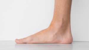 Plattfot og overpronasjon